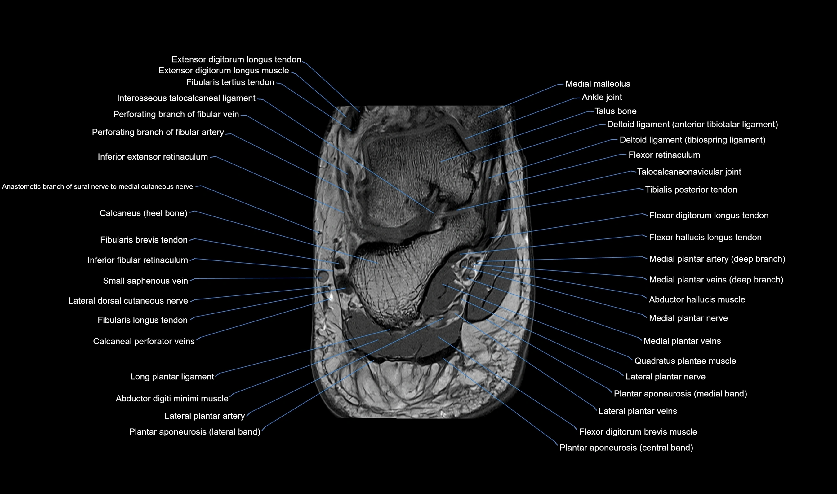 MRI mid foot axial cross sectional anatomy 3T  radiology  image-img-00001-00046.webp